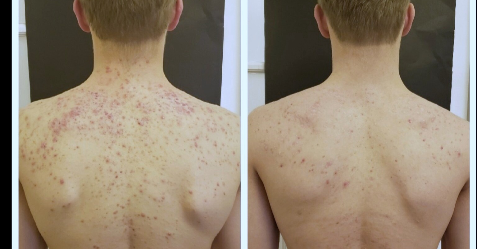 Carbon laser protocol result for back acne before and after