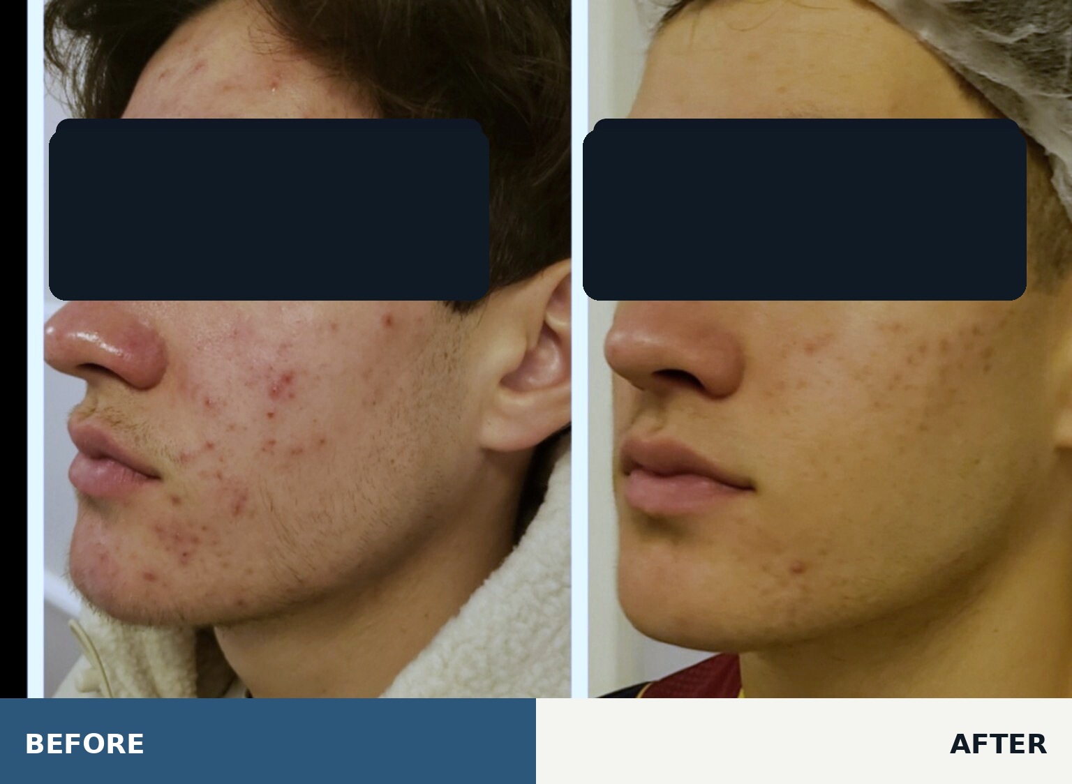 Carbon laser result for facial acne before and after, anonymized for privacy