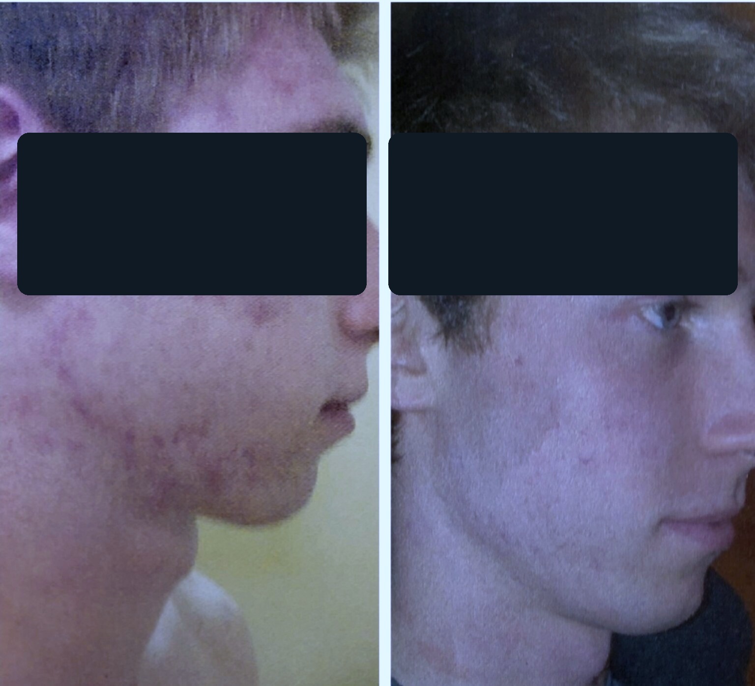 Carbon laser acne protocol result before and after, anonymized for privacy