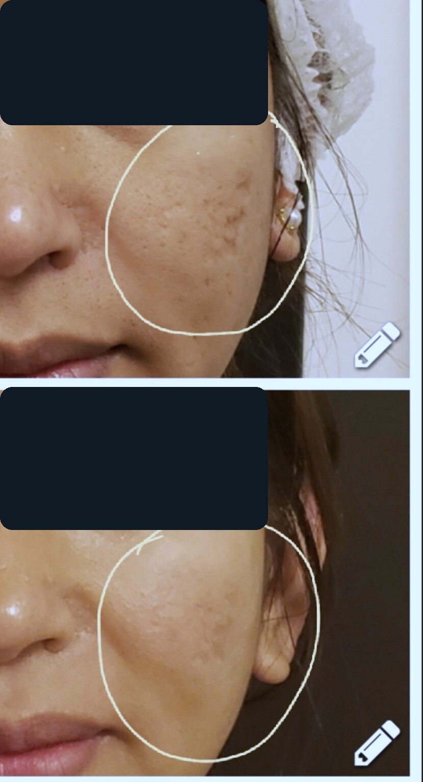 Carbon laser acne scar result before and after, anonymized for privacy