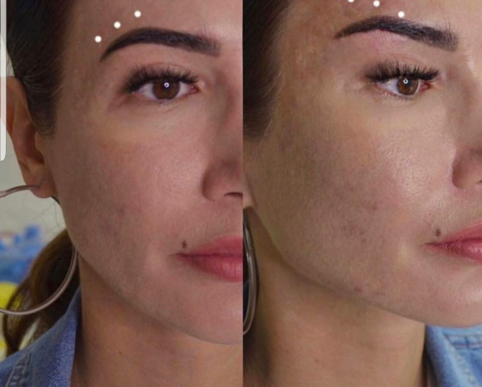 Thread Lift lower-face contour before and after