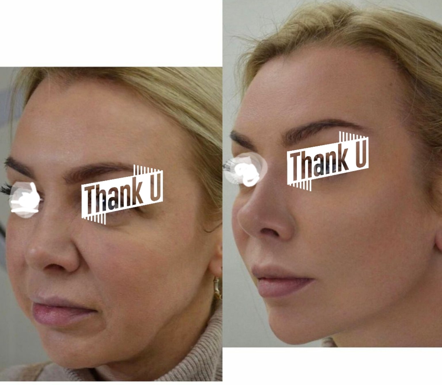 Thread Lift facial contour before and after with eyes covered