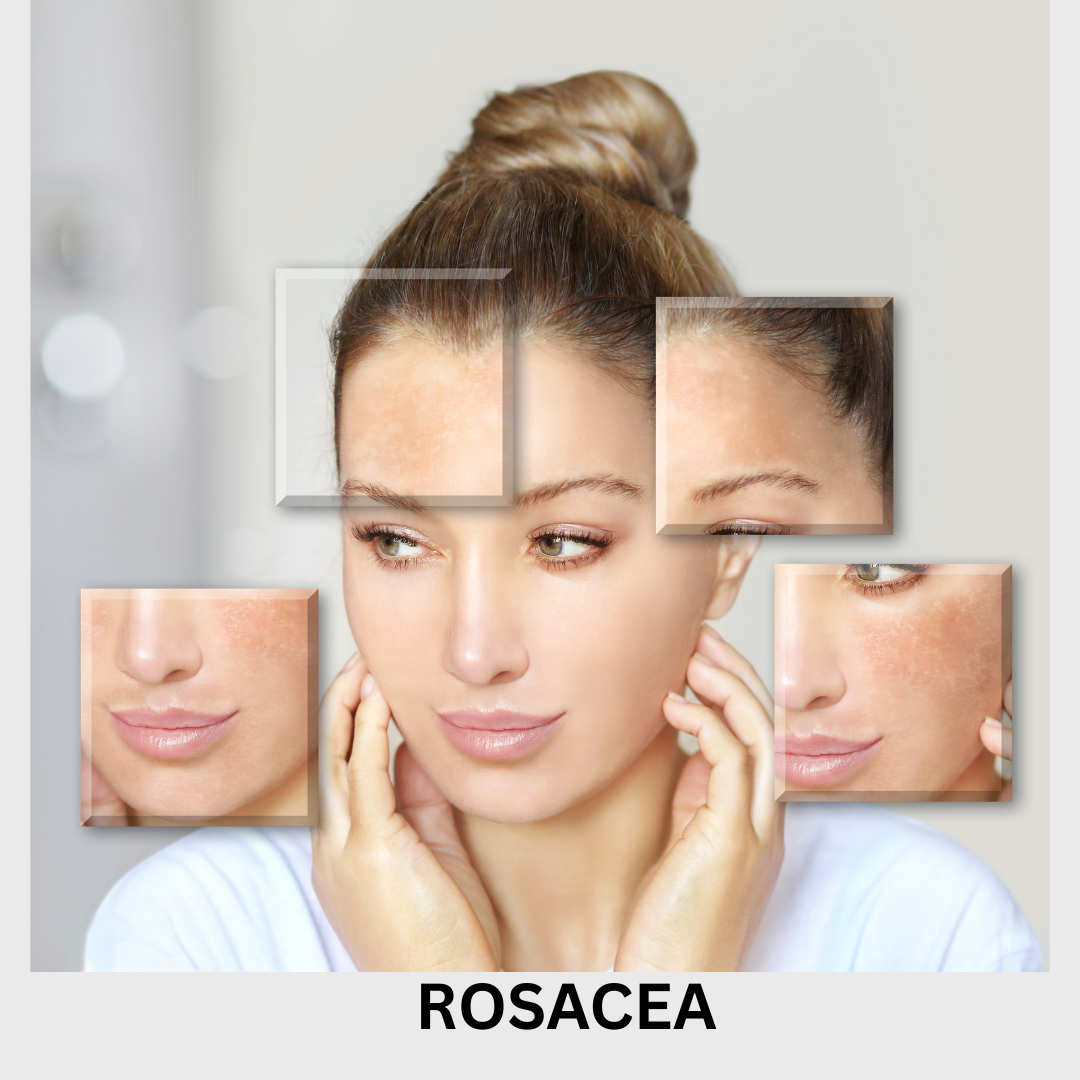 10. Rosacea