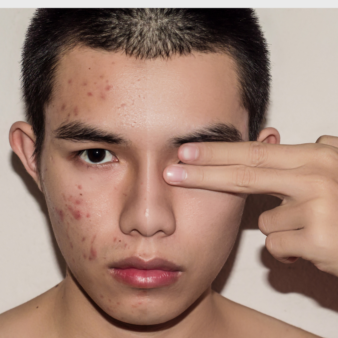 1. Acne